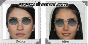 nose-surgery-79.jpg