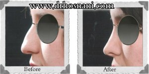 nose-surgery-1.jpg