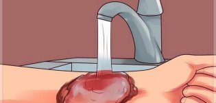 كيفية_علاج_الحروق.jpg كيفية_علاج_الحروق.jpg